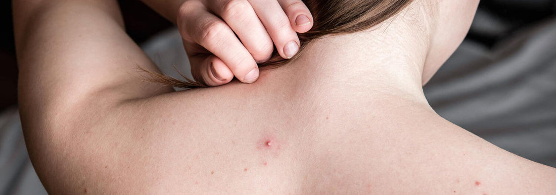 Trądzik na plecach: Przyczyny, sposoby leczenia i pielęgnacja skóry potrądzikowej